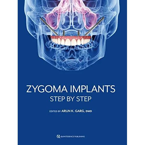 Zygoma Implants: Step by Step