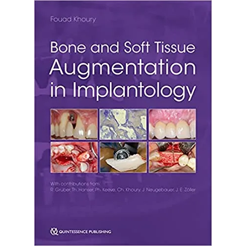 Bone and Soft Tissue Augmentation in Implantology