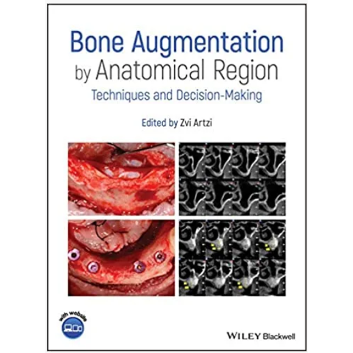 Bone Augmentation by Anatomical Region: Techniques and Decision-Making