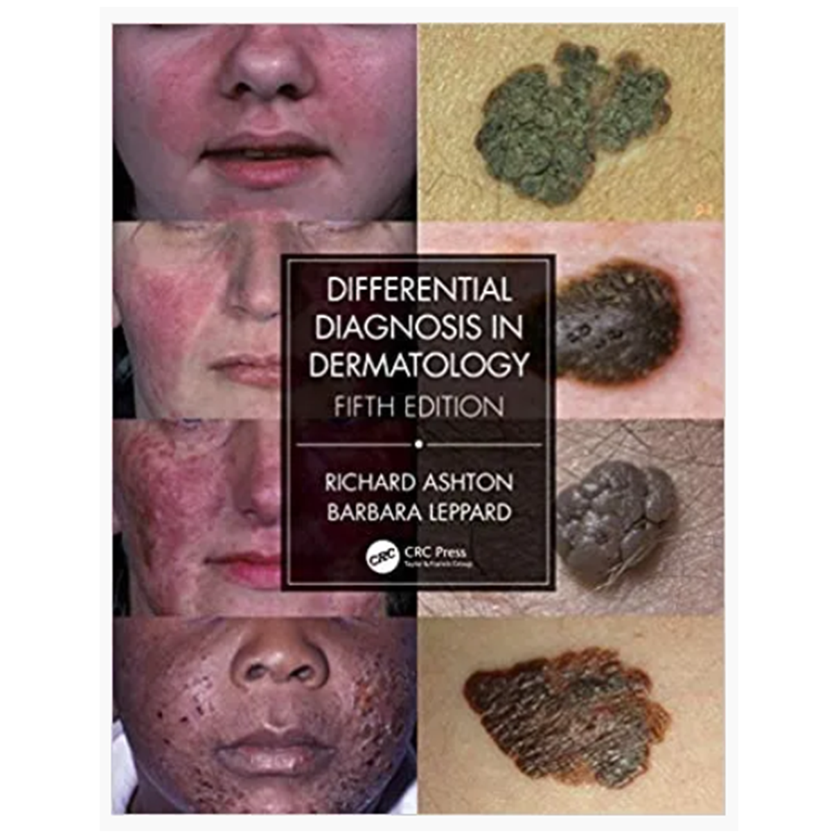 Differential Diagnosis in Dermatology