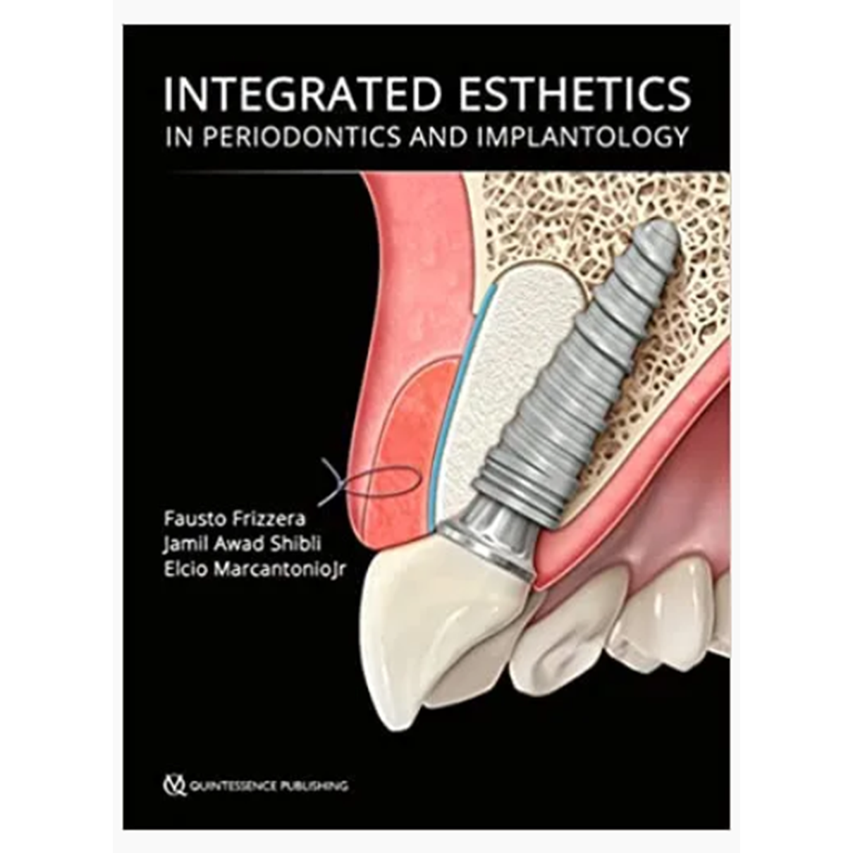 Integrated Esthetics in Periodontics and Implantology