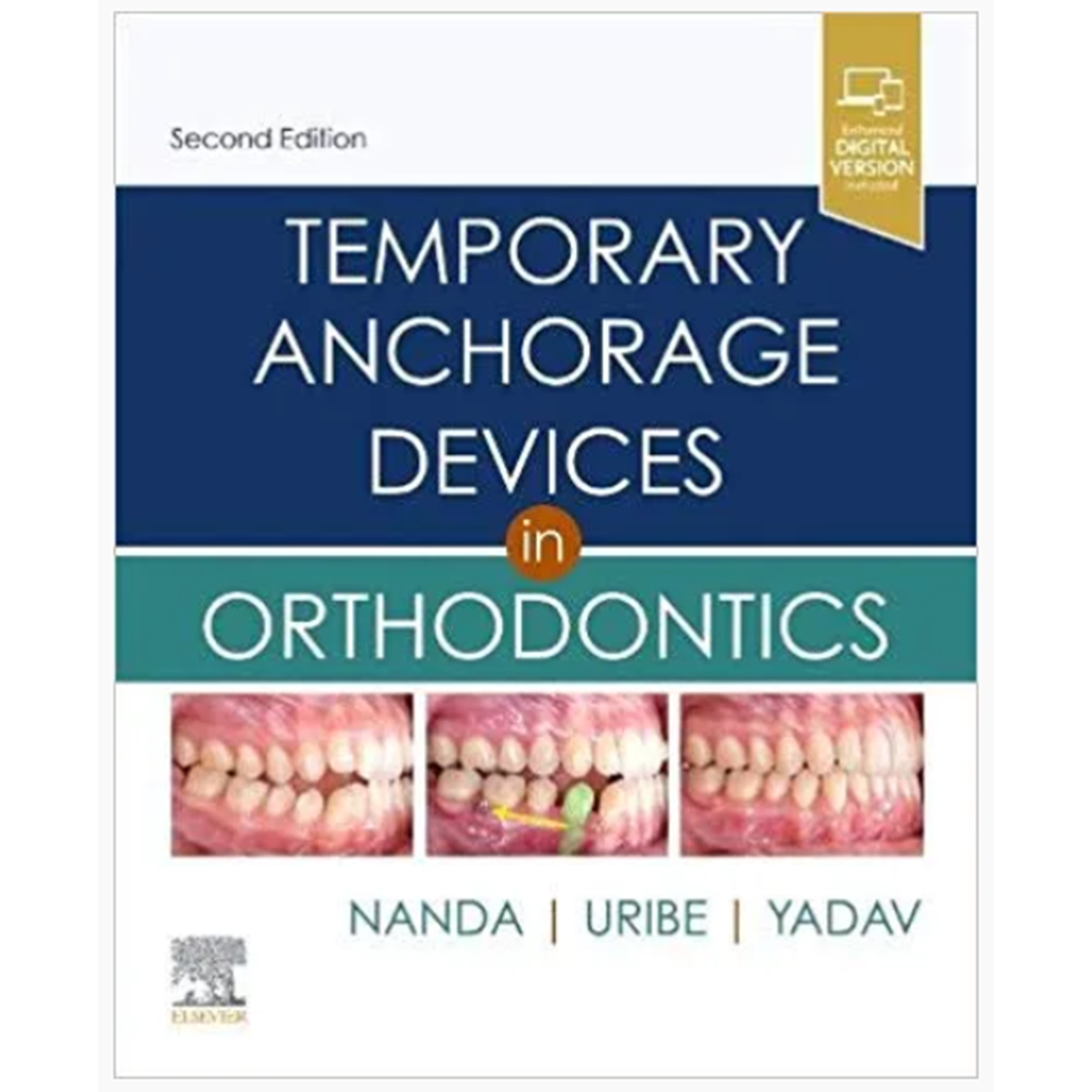 Temporary Anchorage Devices in Orthodontics